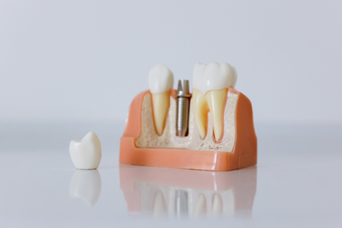 implantes dentales